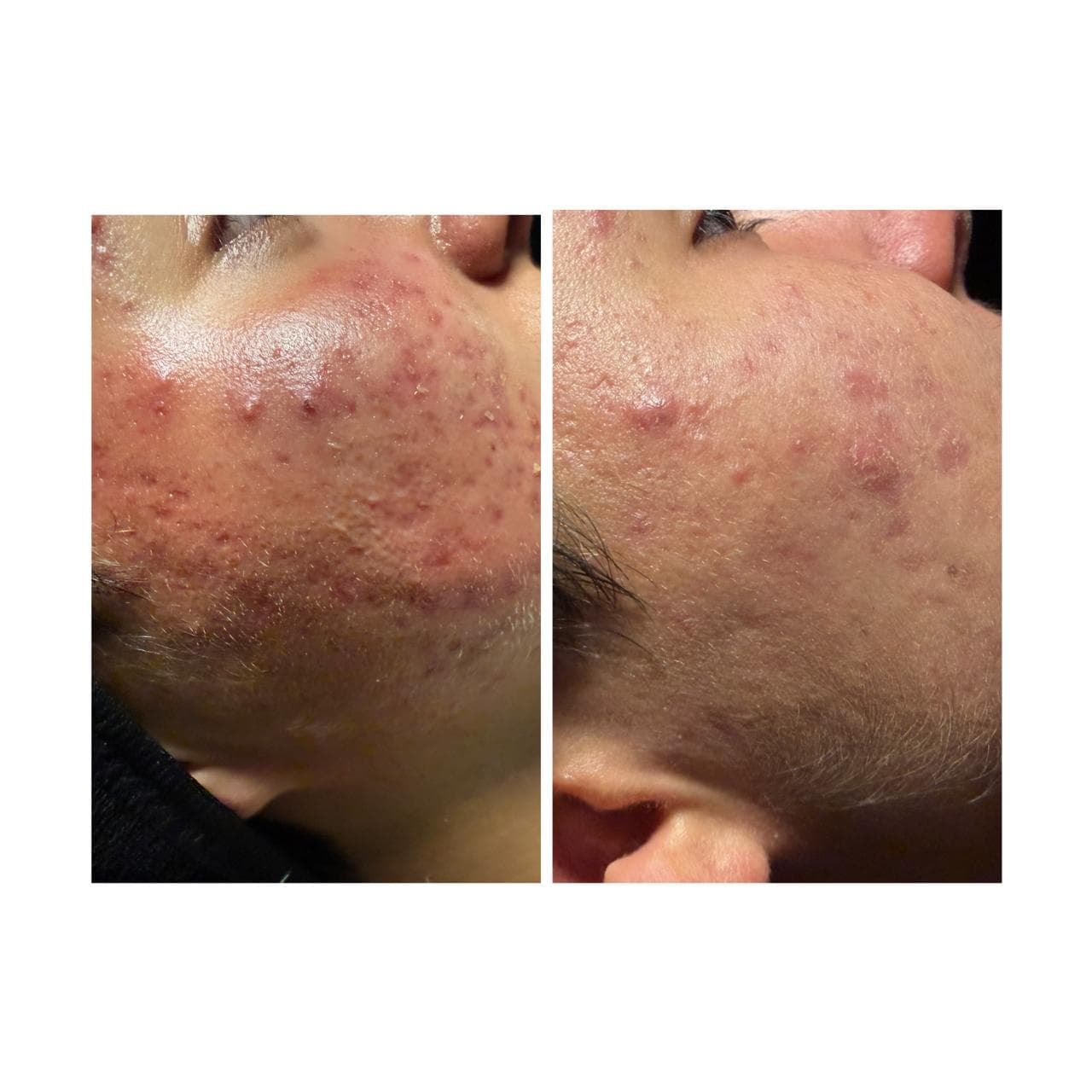 Comparación de antes y después mostrando mejoría del acné facial y reducción de la inflamación.