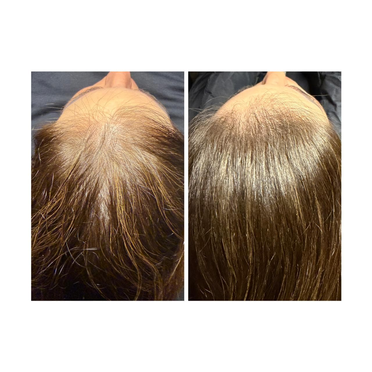 Antes y después de un tratamiento capilar mostrando una mayor densidad de cabello castaño.