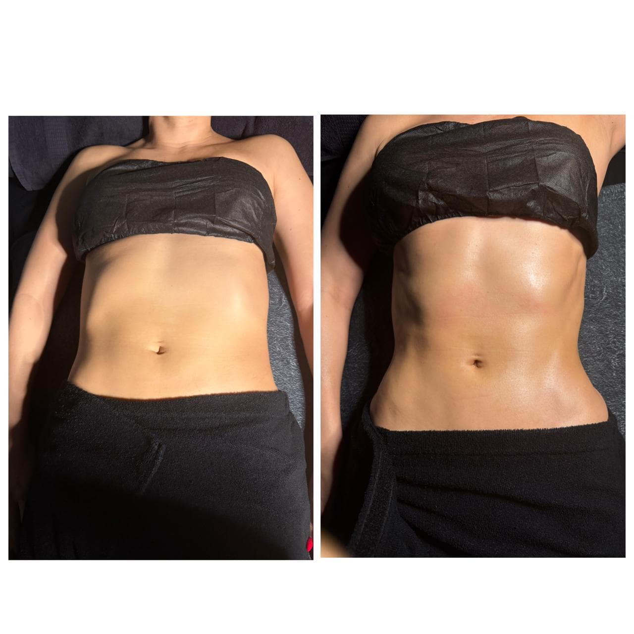 Abdomen antes y después de un tratamiento estético, mostrando una silueta más definida y tonificada.