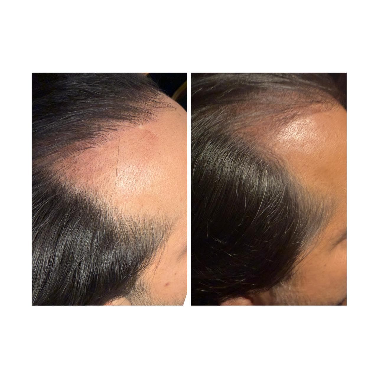 Antes y después de un trasplante capilar mostrando una línea de cabello más densa.