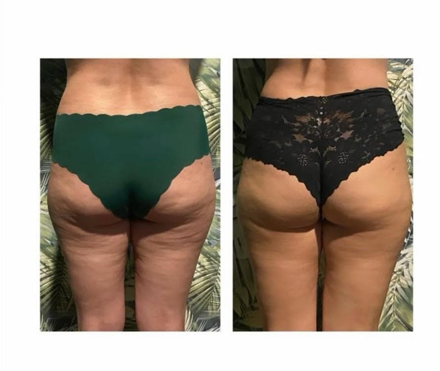Comparación de antes y después mostrando una notable reducción de celulitis en glúteos y muslos.