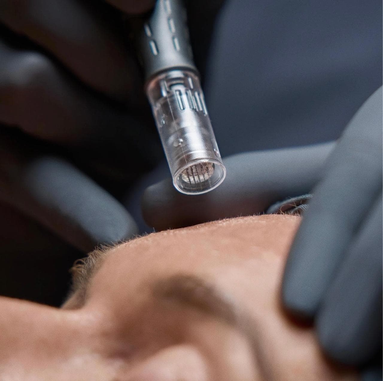 Dispositivo de microneedling aplicado en la frente de un paciente durante un tratamiento facial estético.